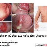 Bao quy đầu ra mủ là dấu hiệu của bệnh gì?