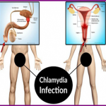 Bị Chlamydia mãn tính: Dấu hiệu nhận biết và cách điều trị