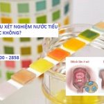 Bệnh lậu xét nghiệm nước tiểu có được không?