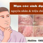 Bệnh mụn cóc sinh dục và những điều nam nữ cần biết